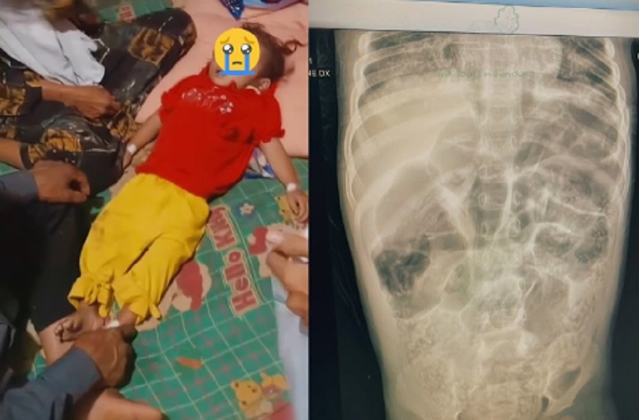 Ilustrasi cacingan anak untuk artikel Cacingan Anak Bikin Stunting, Jangan Anggap Sepele